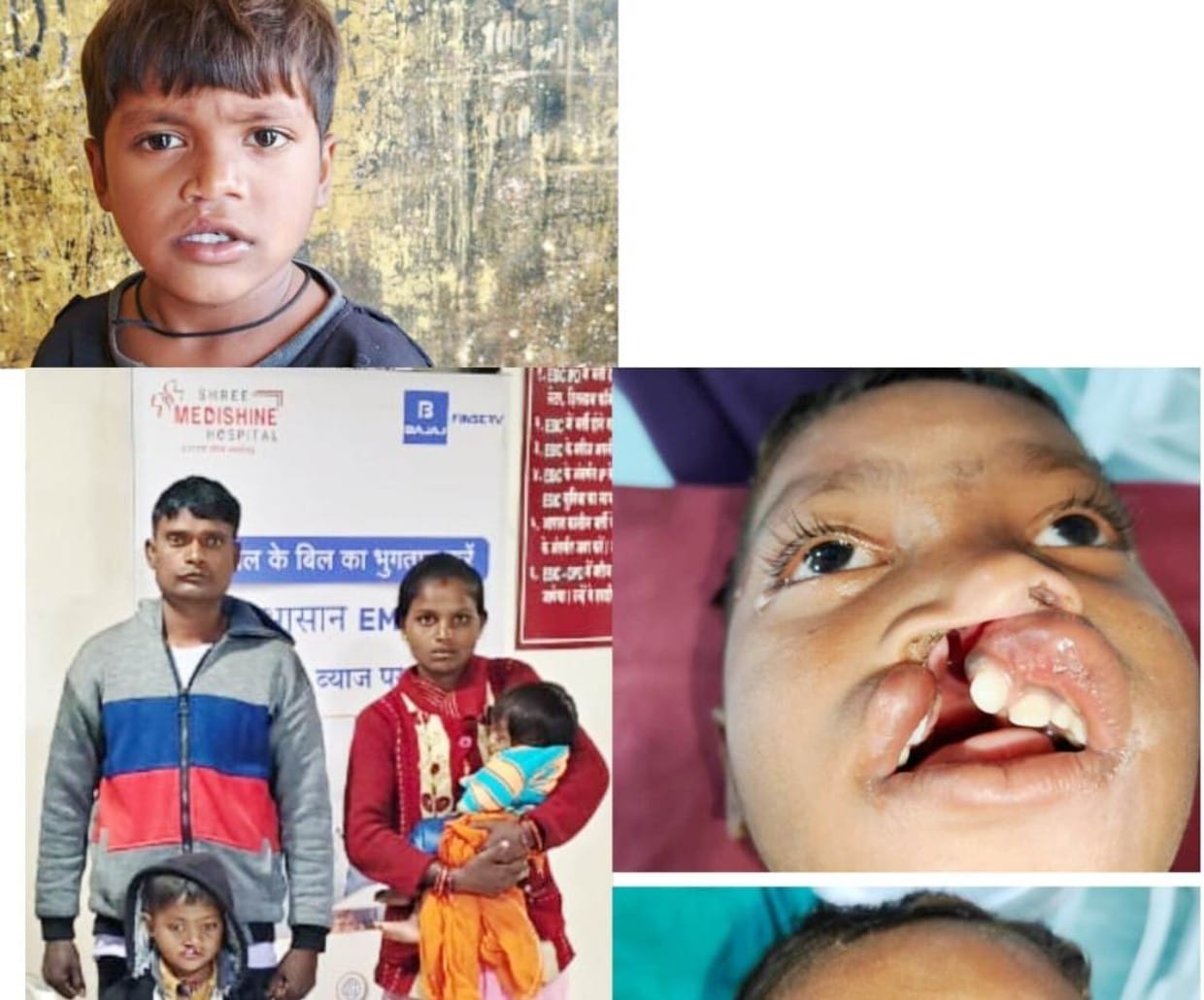 खिलखिलाती मुस्कान की नई इबारत लिख रहा बस्तर के वनांचल से नन्हा विक्रम,, दिव्यांग चिरायु निःशुल्क योजना